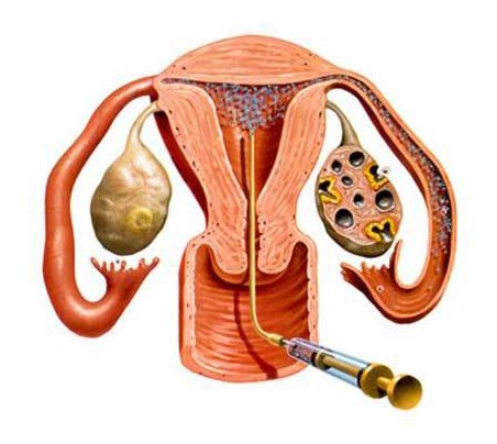 Uterus